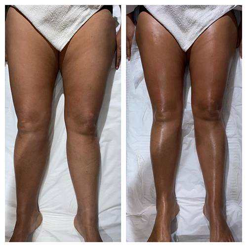 Le drainage Lymphatique révolutionnaire pour un corps resculpté près de Montpellier